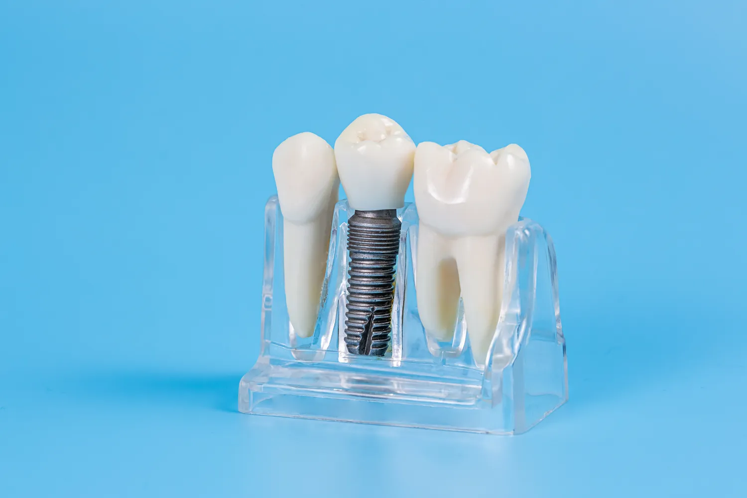 Implant stomatologiczny z Wrocławia