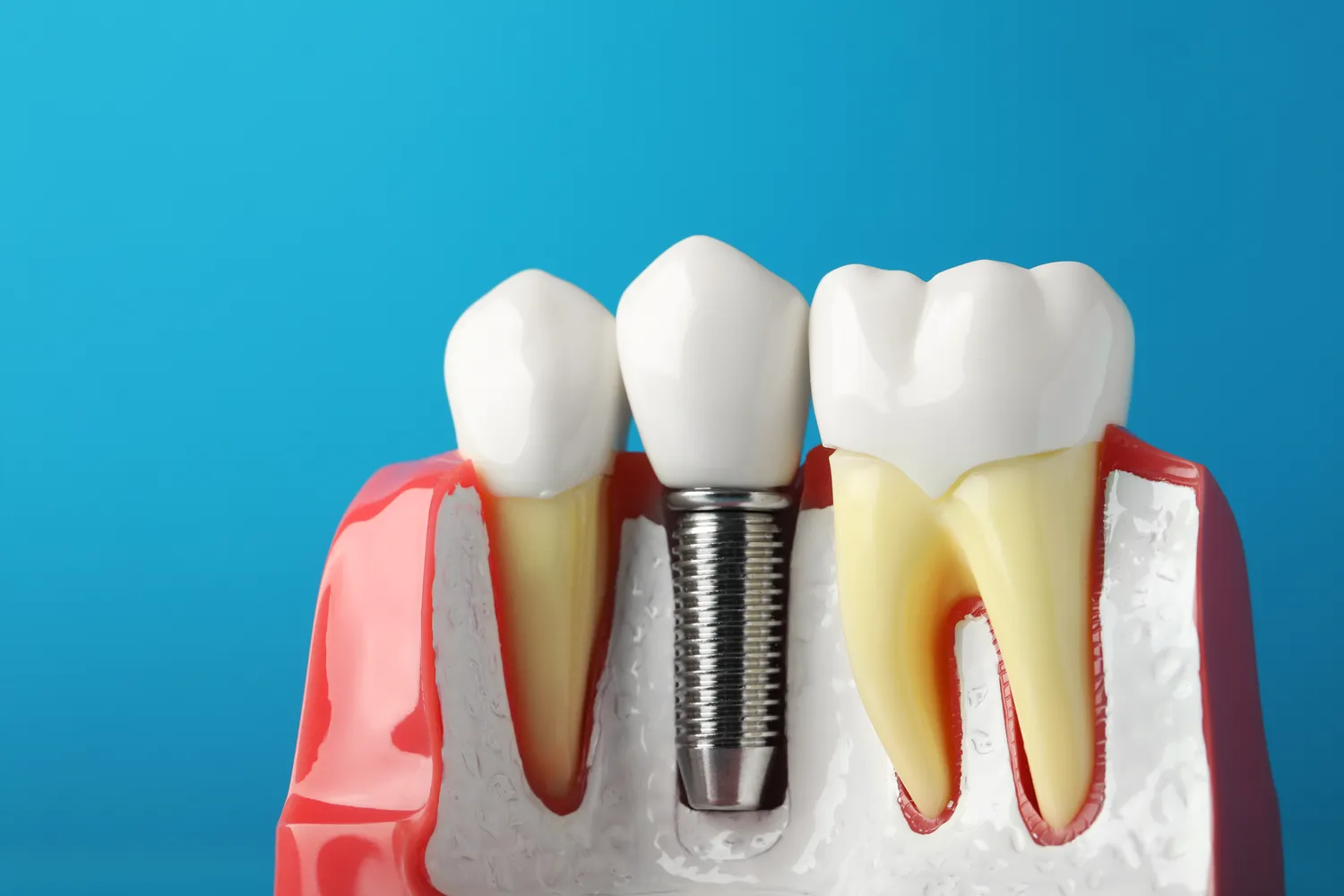 Jakie są rodzaje implantów zębowych?