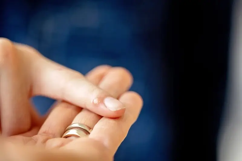 Ile leczy się kurzajki?